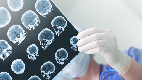 Schlaganfall – Unterschiedliche Risikofaktoren und Symptome bei Frauen und Männern -  Experten-Interview mit Carsten Sellmer, Gesundheitsexperte von der IDEAL Versicherung